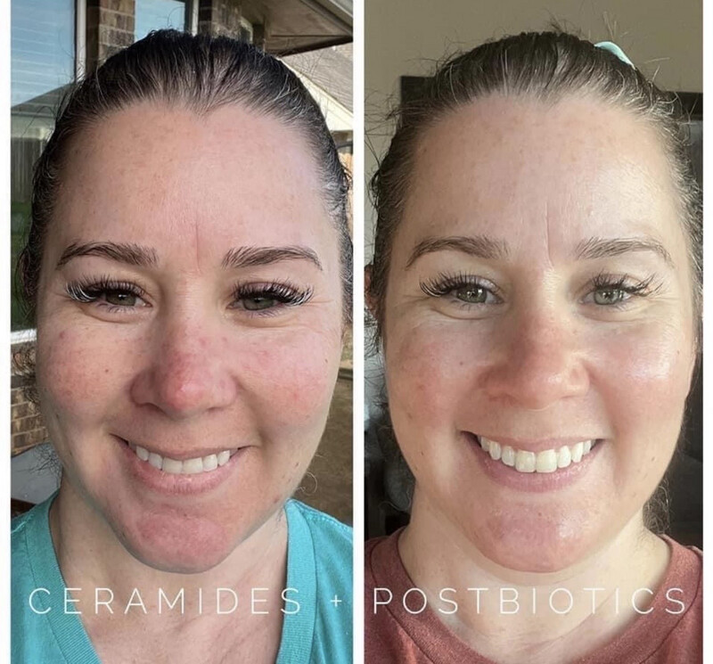 Ceramides and Postbiotics