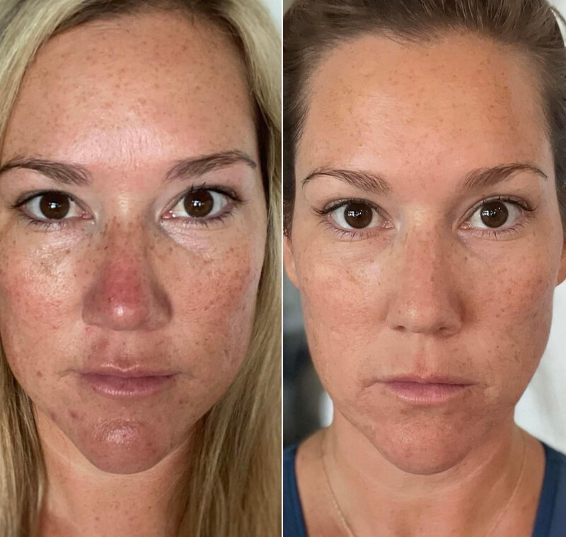Collagen