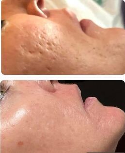 AHA Facial Peel Pads-Chemical peel at home!
