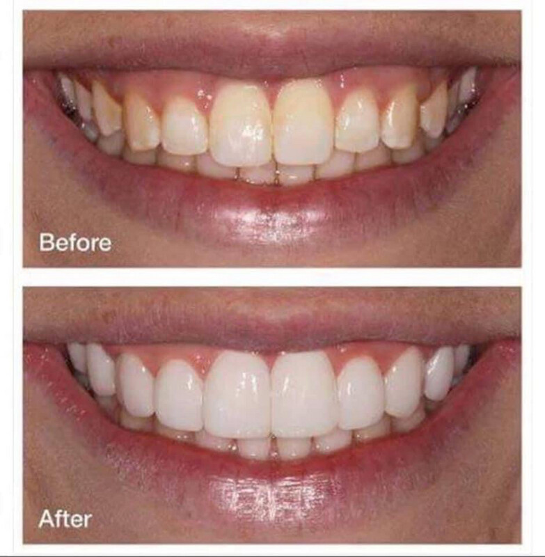 Whitening Toothpaste