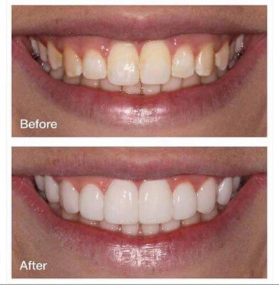 Whitening Toothpaste