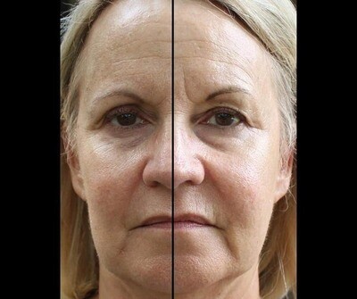 Anti Aging