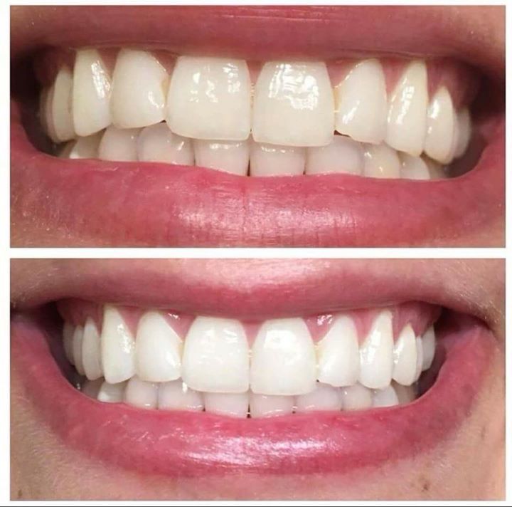 5pk Whitening Toothpaste