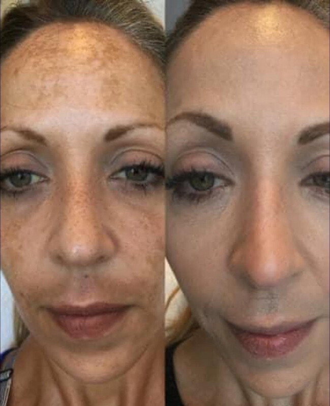 AHA PEEL plus A Free 180 Facewash And Celltrex Recovery Masks