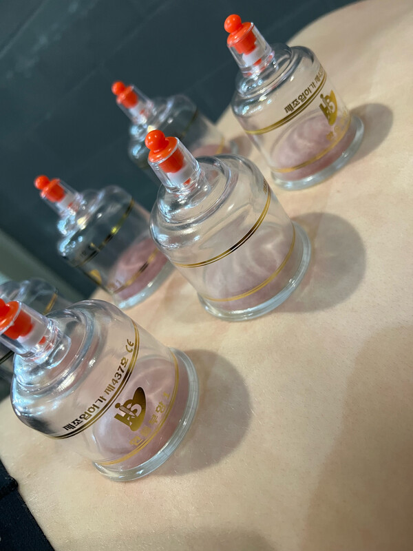 Combination Treatment Including Dry Myofascial Cupping £32 (30mins) £42 (45 Minutes) / £48 (60 Minutes)