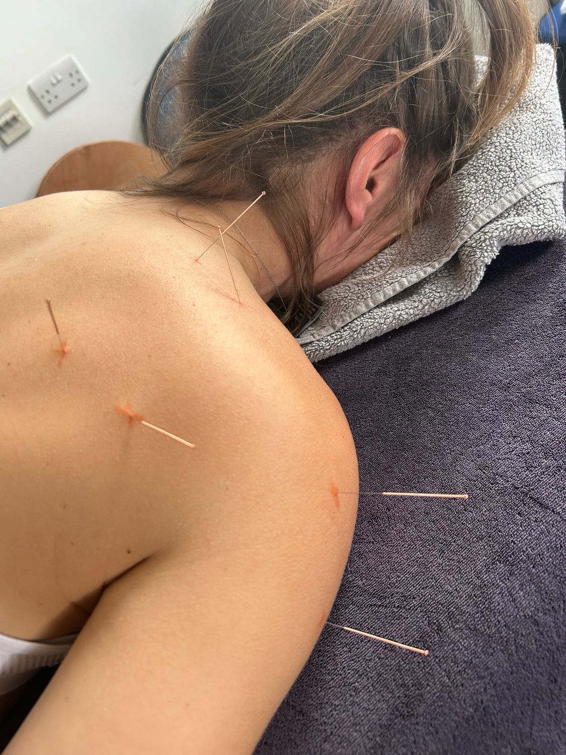 Medical Acupuncture coming soon…