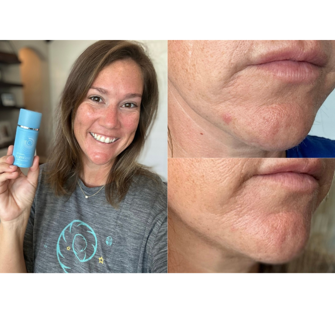 Blemish Serum