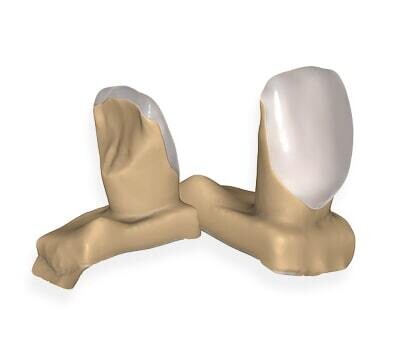 Veneers