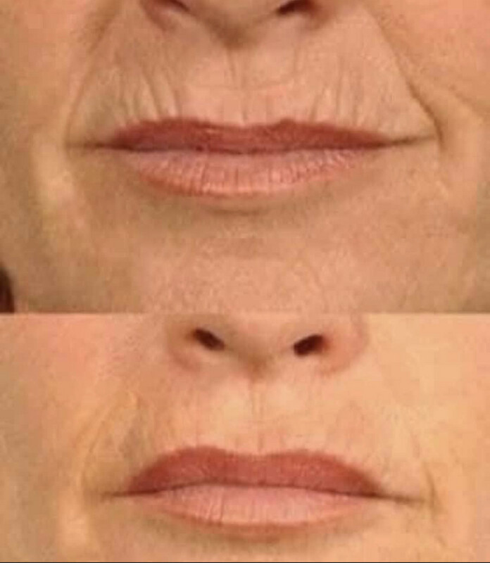 Line Corrector