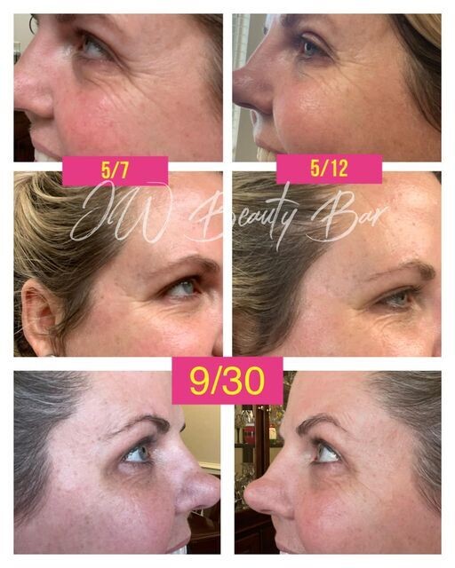Tru Face Line Corrector