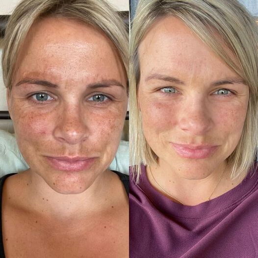 AHA Facial Peel Pads