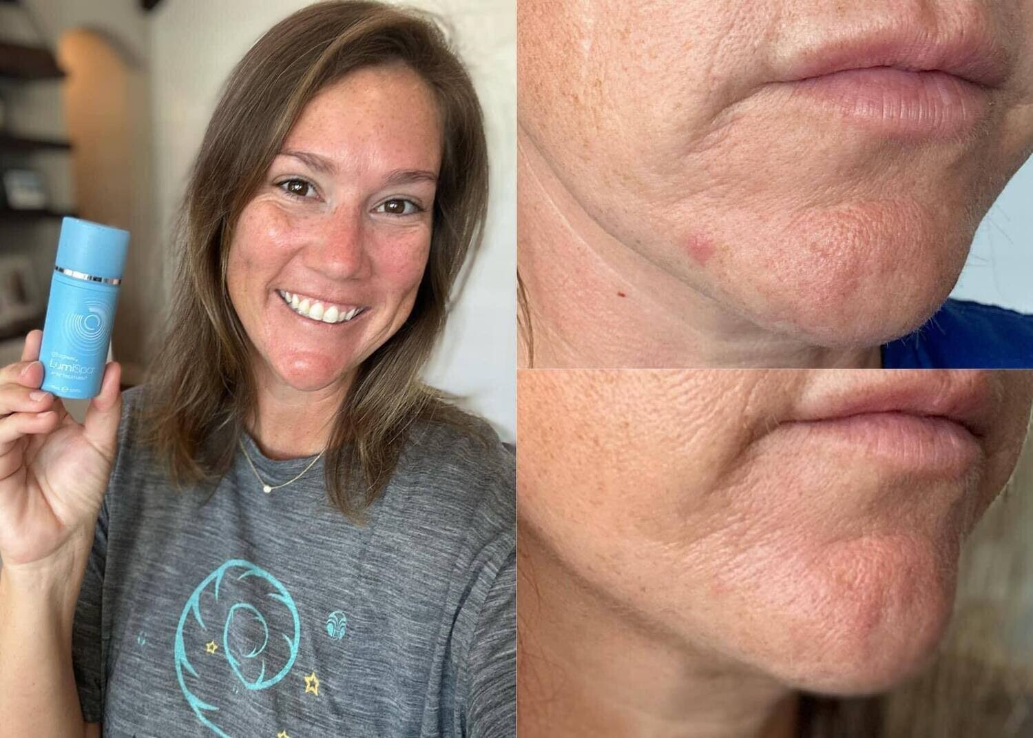 ageLOC Blemish Serum