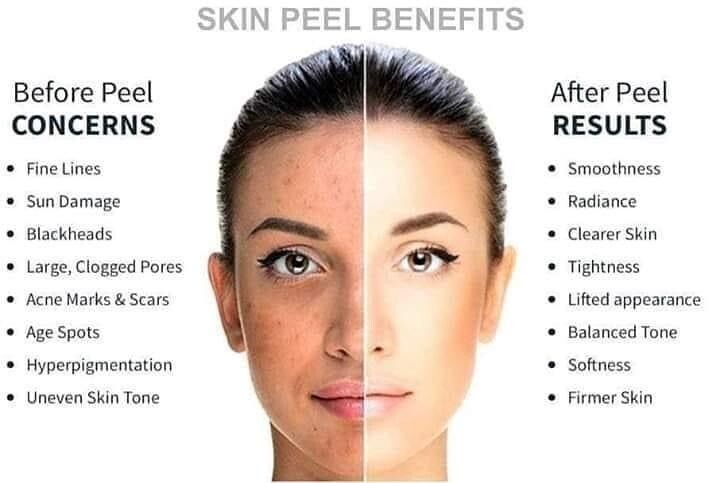 180°® AHA Facial Peel and Neutralizer
