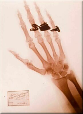 Hand X-Ray Magnet
