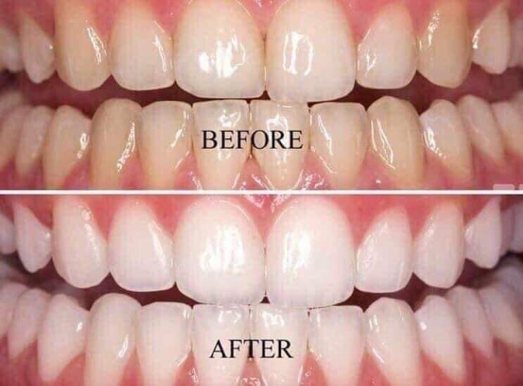 Whitening Toothpaste