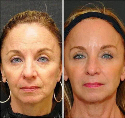 Anti-Aging Uplifting Cream Moisturizer