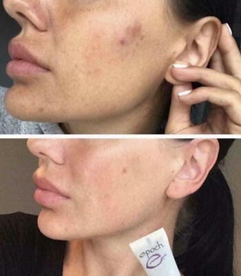 Epoch® Blemish Treatment (for occasional breakouts)