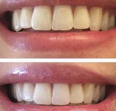 Whitening Toothpaste