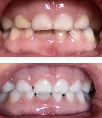 Whitening Toothpaste