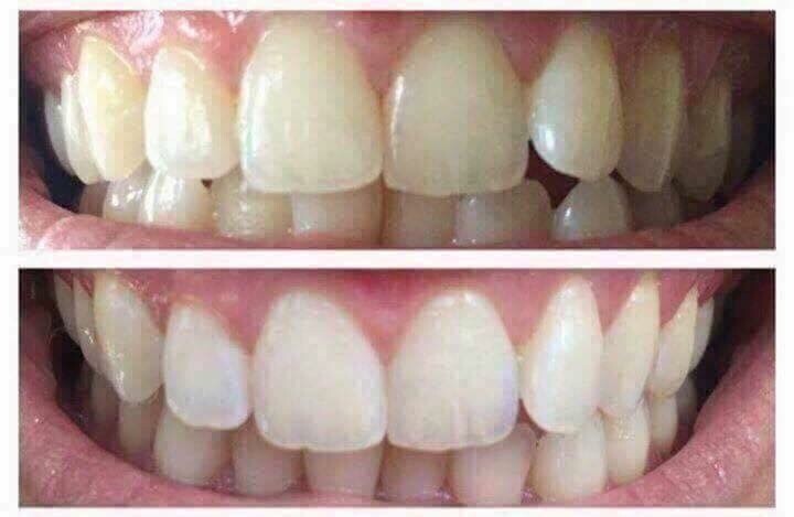 Whitening Toothpaste