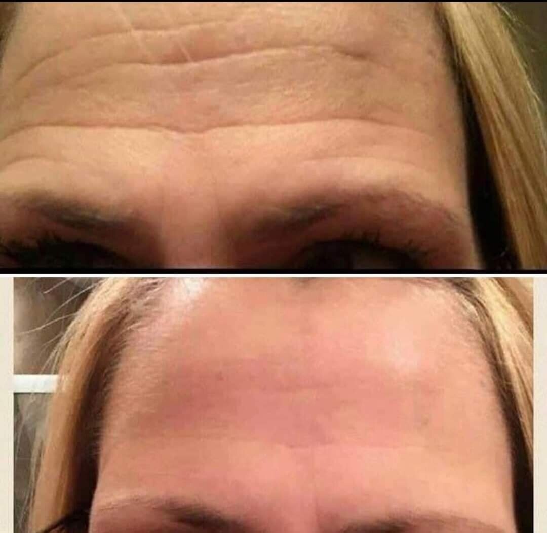 Age Loc Line Corrector