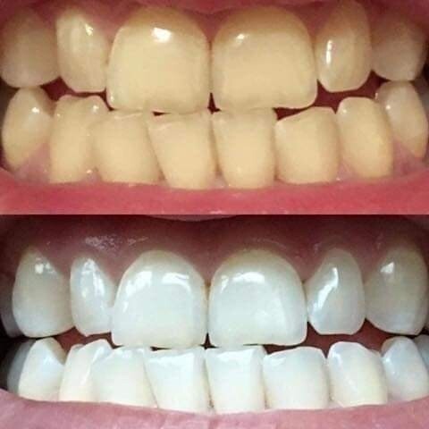 Whitening Toothpaste