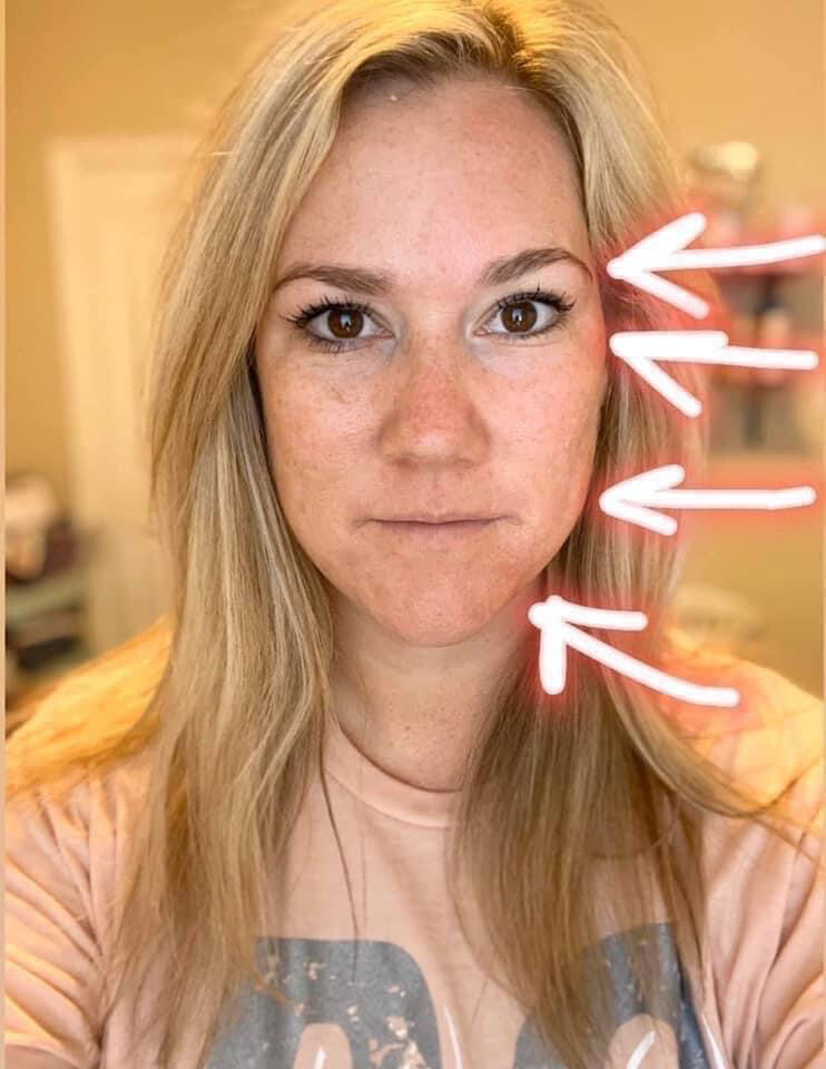 Face Lift