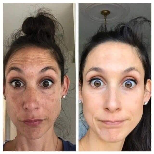 180 AHA Facial Peel