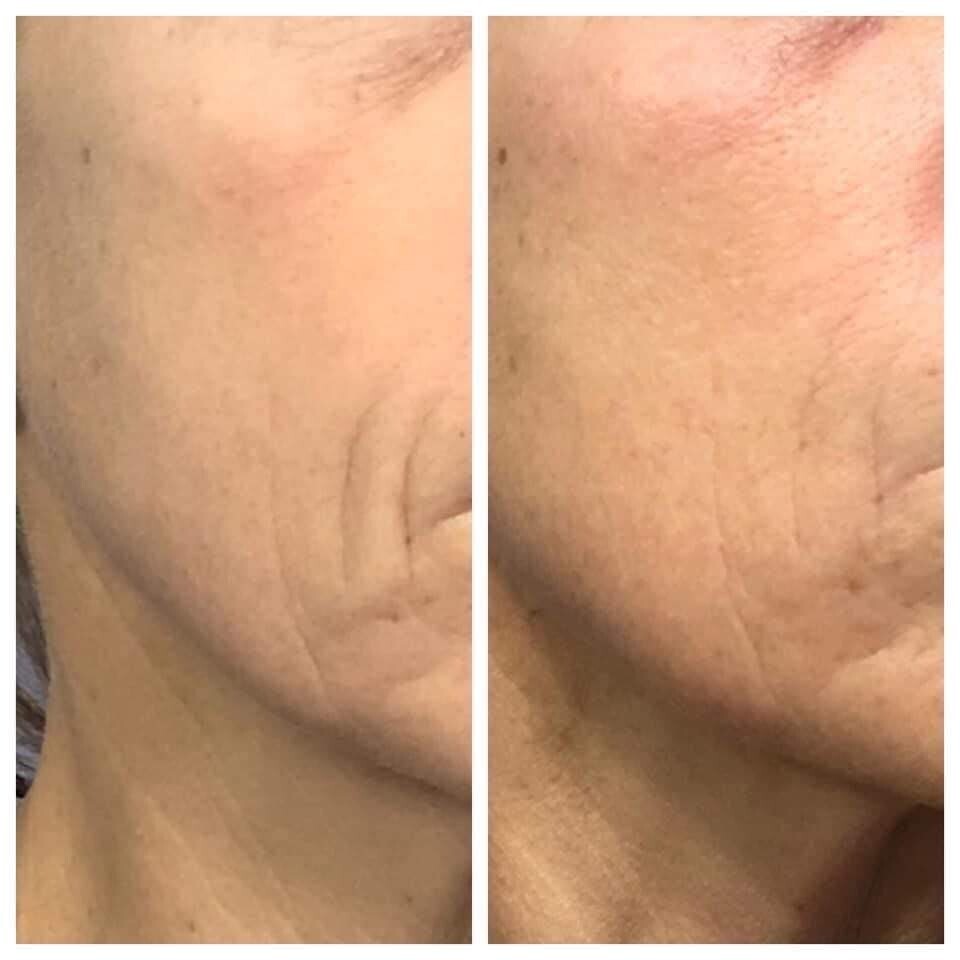 Tru Face Line Corrector