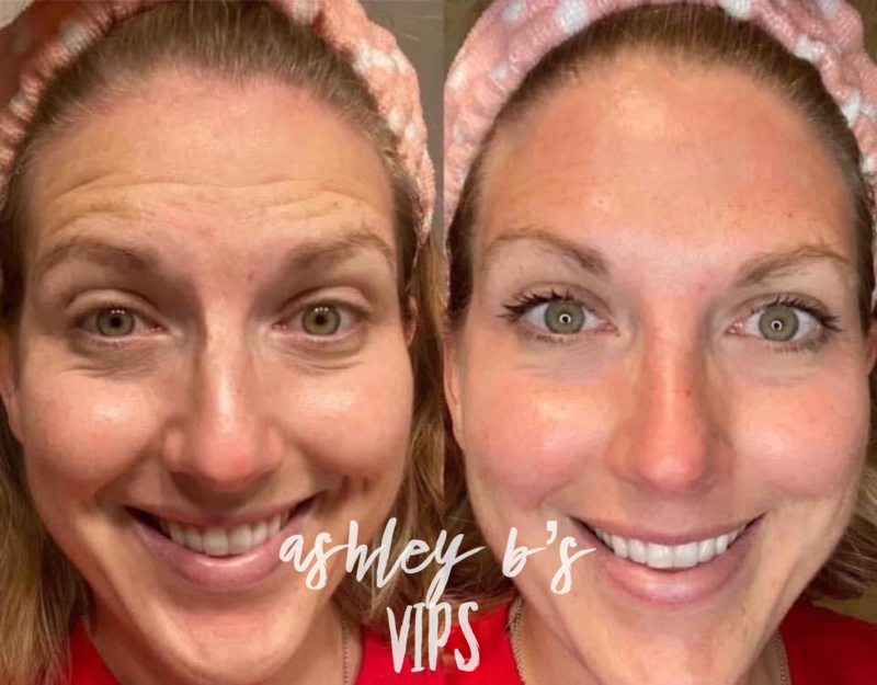 Face lift