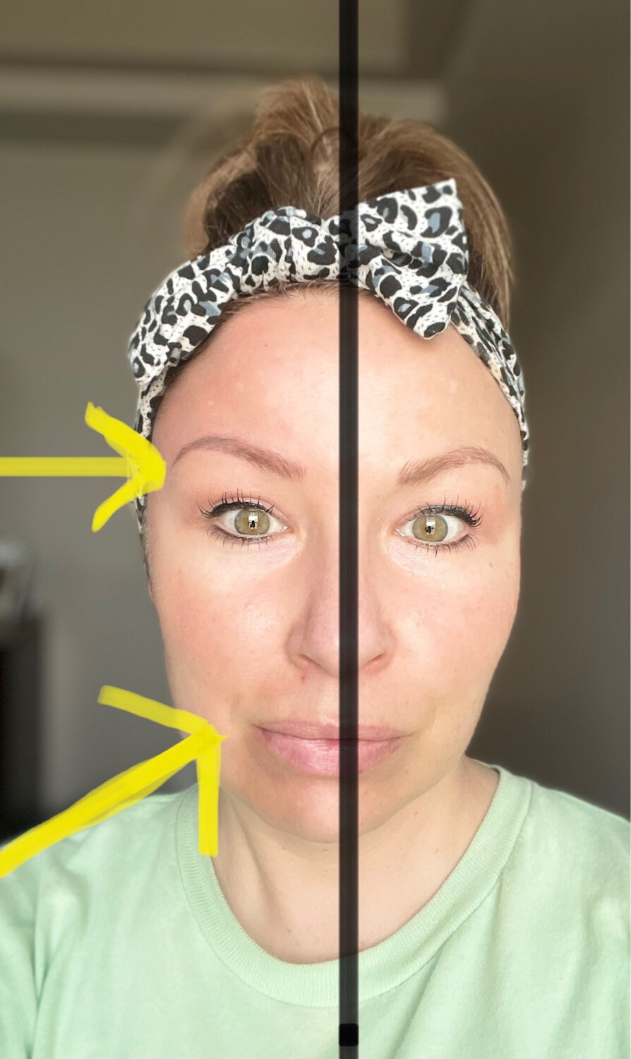 Face lift