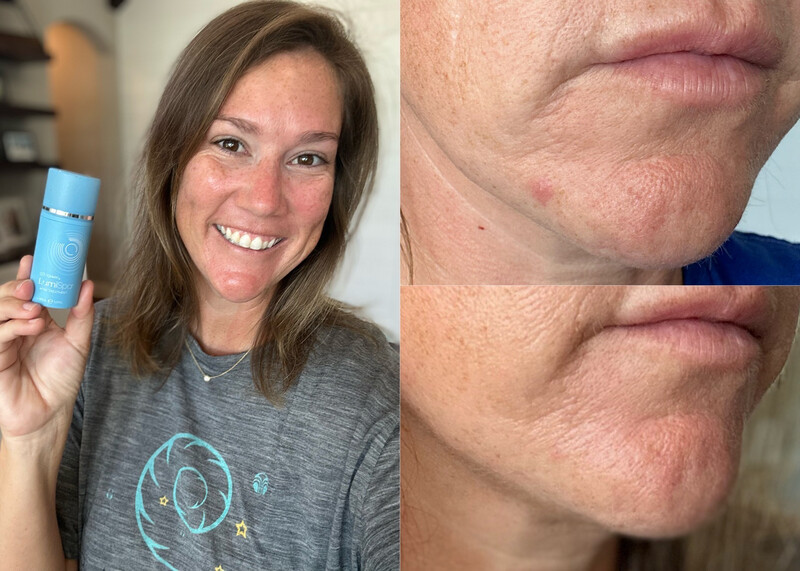 Blemish serum