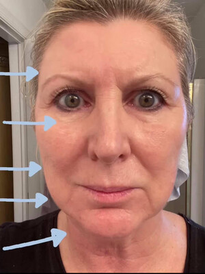 Face Lift
