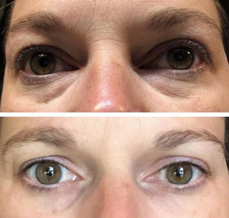 ageLoc Ideal Eyes