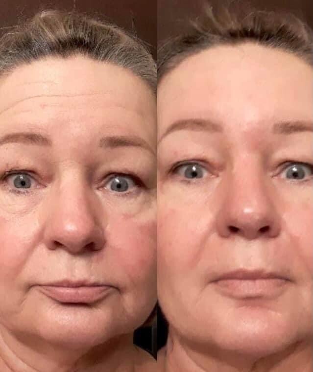Face Lift Treatment