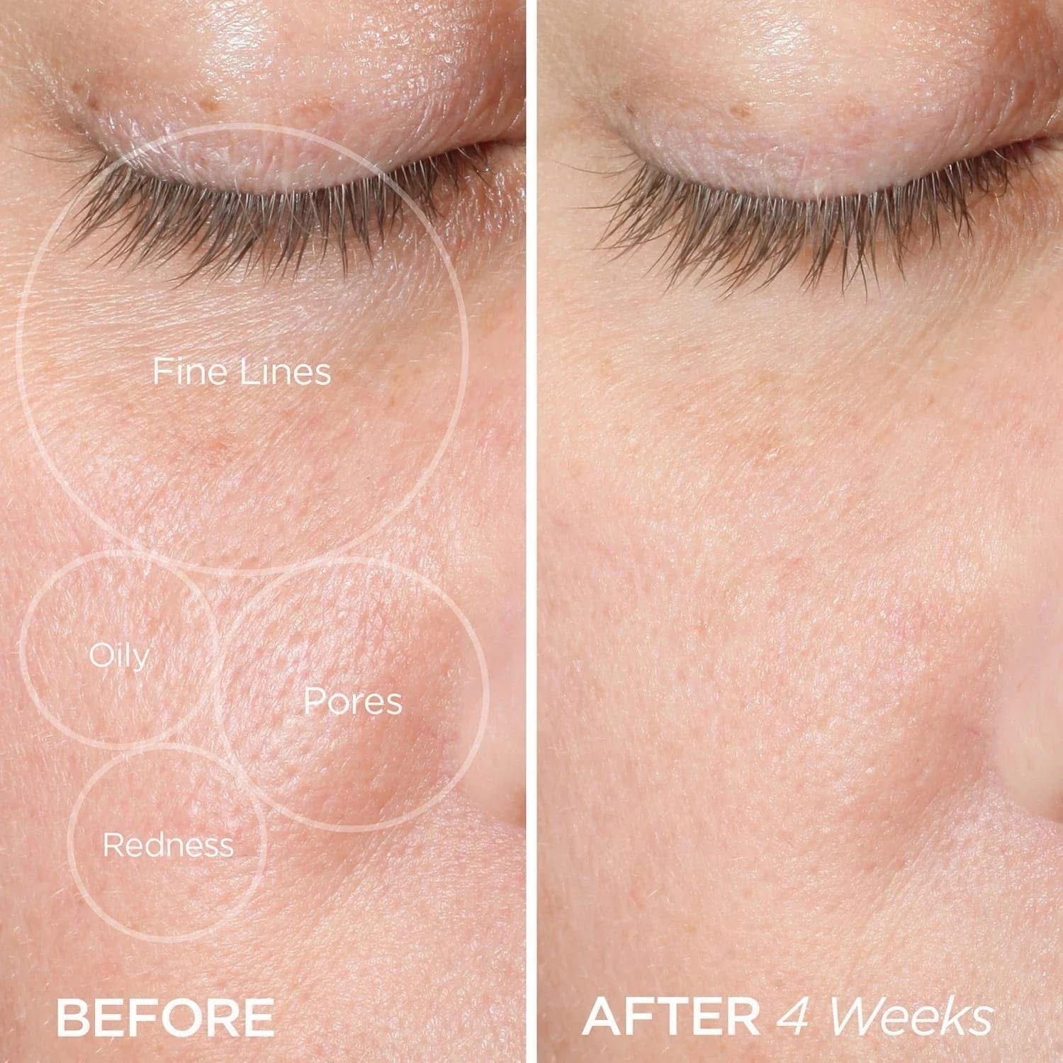 Red Light + Micro Needling Bundle