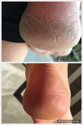 Pedi Cream Sole Solution Sale - Pedi Cream Sole Solution Sale -