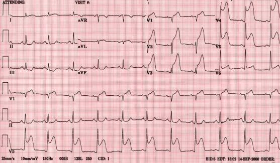Electrocardiogramas en papel.