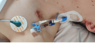 Catéter intravenosos central ficticio. Alquiler vía central UCI.