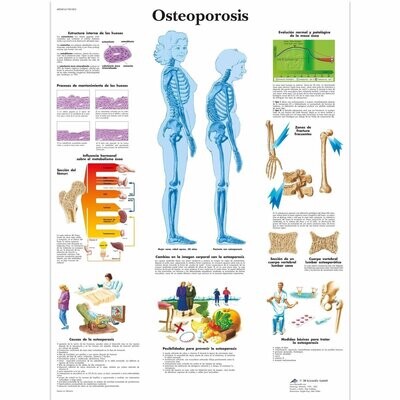 Lamina de la Osteoporosis