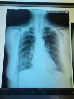 Radiografía de tórax.