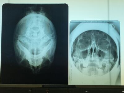 Tomografía de cráneo RX. Años 50