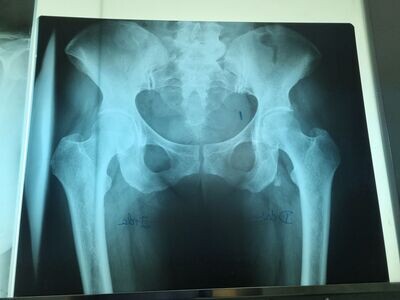 Radiografía de cadera grande.