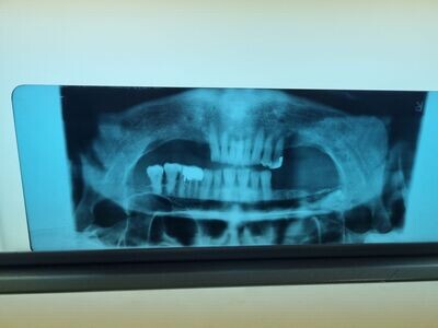 Radiografía pequeña dental.