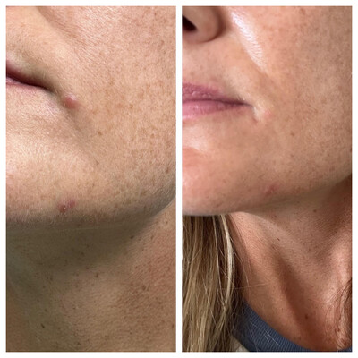 Lumispa Blemish Serum