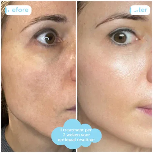 HYDRATING Micro Infusion Treatment 1 applicatie