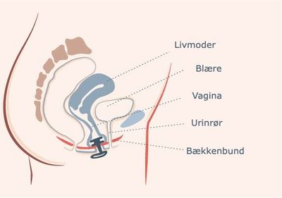 Vaginale pessarer til inkontinens