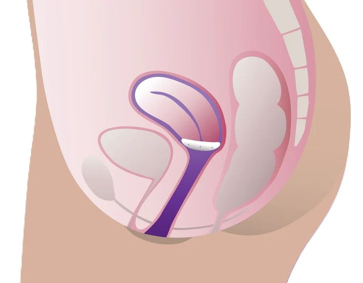 ProFem® Shaatz Prolapsring