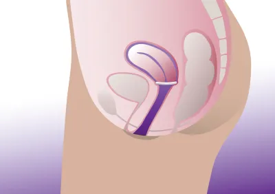ProFem® Oval Prolapsring
