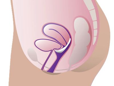 ProFem® Marland Prolapsring